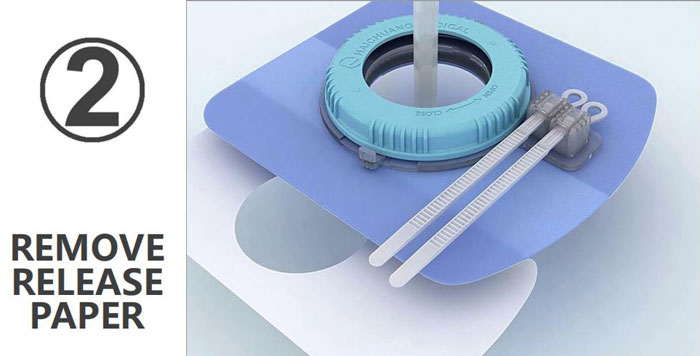 Loopix Drainage Catheter Fixing Device Application Step