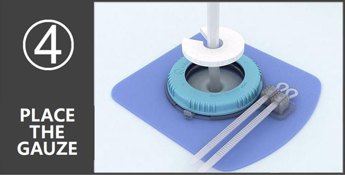 Loopix Drainage Drainage Catheter Fixing Device خطوة التطبيق