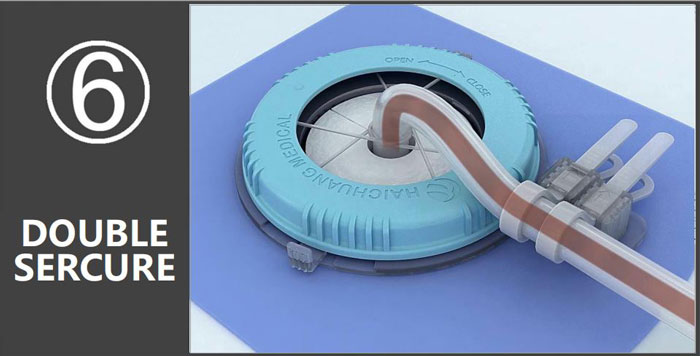 Loopix Drainage Catheter แก้ไขขั้นตอนการสมัครอุปกรณ์