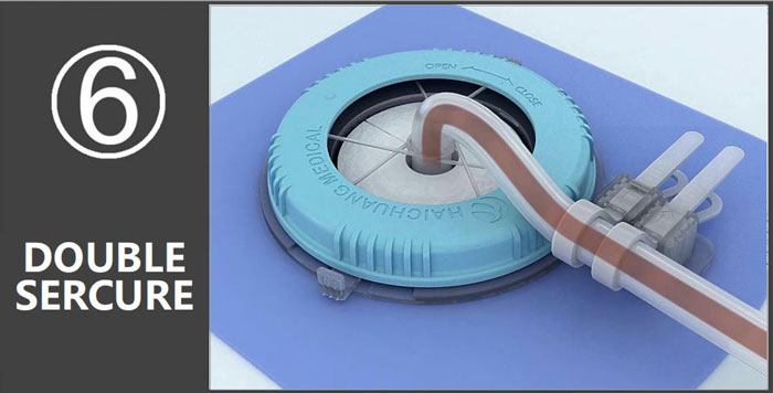 Loopix Drainage Catheter Fixing Device Application Step