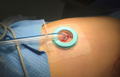 Loopix-Katheter-sicher-angewendet-in-der-Thorax-Chirurgie