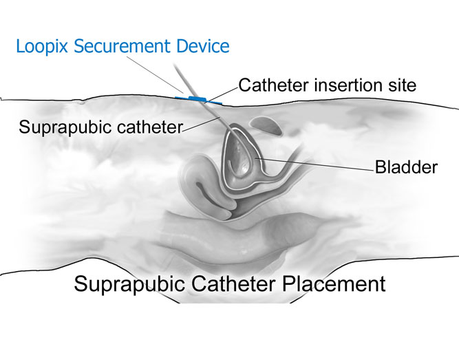 Suprapubischer-Katheter-Sicherungs-Loopix