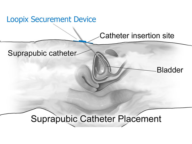 Suprapúbico-Cateter-Securing-Loopix