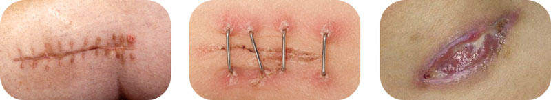 Disadvantages of Suture, Staple and Glue