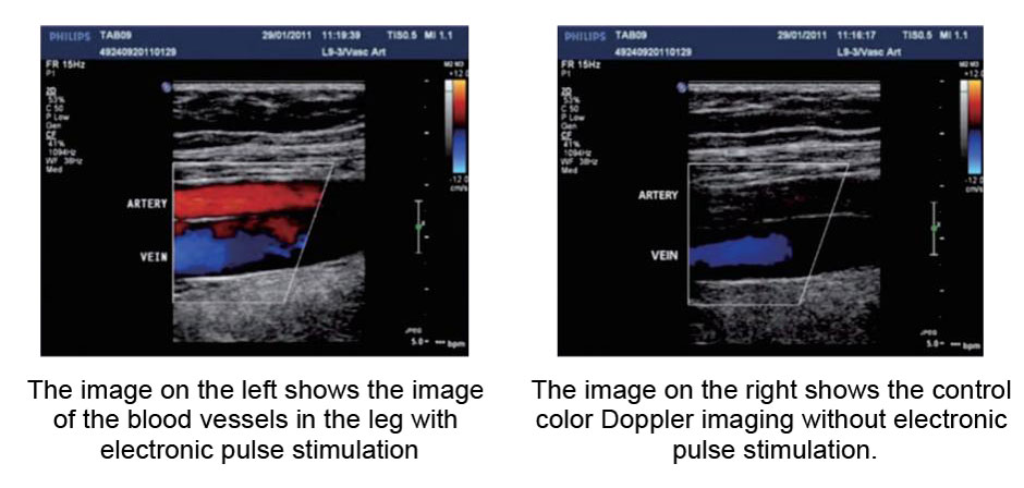 Efecto clínico del estimulador eléctrico neuromuscular DVT-A