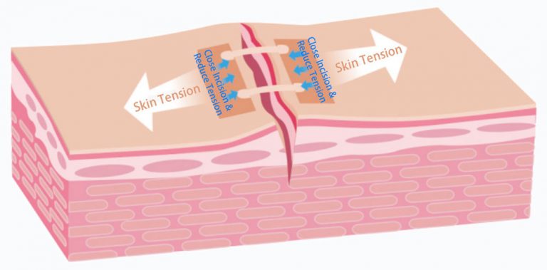 A-drawing-depicts-that-the-device-close-incision-and-reduce-tension