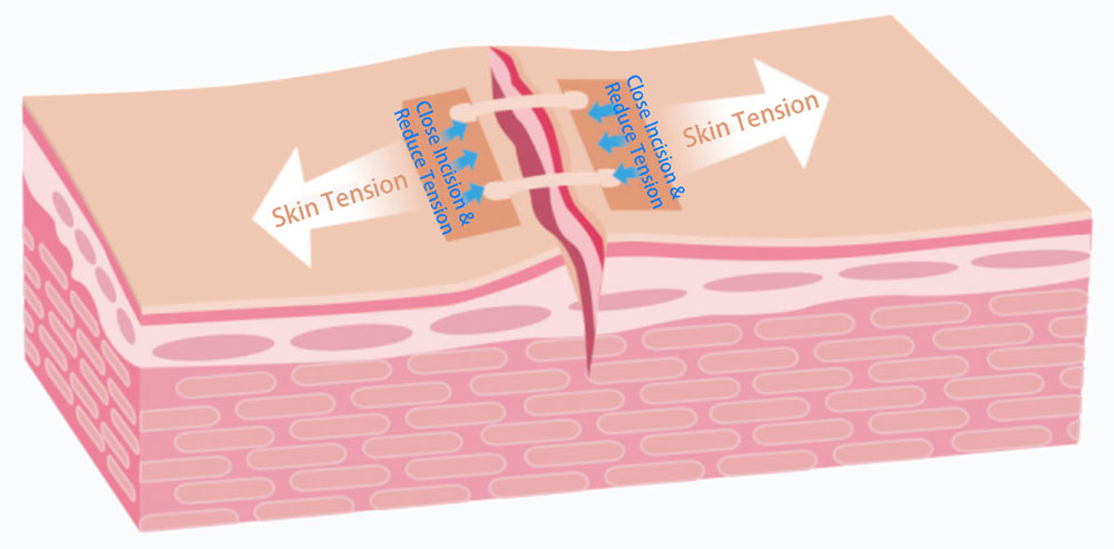 A-drawing-depicts-that-the-device-close-incision-and-reduce-tension