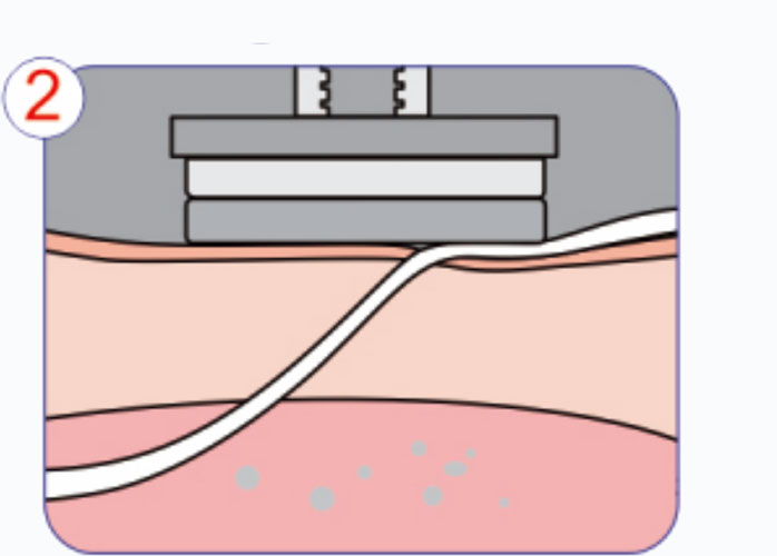 Aplicação-Procedimento-do-Dispositivo-Hemostato-da-Artéria-Radial Etapa 2