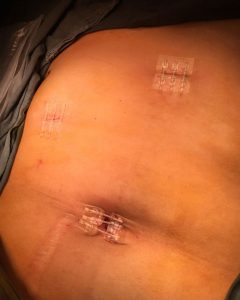 BI-FIX-Wound-Closure-in-Endoscopic-surgery