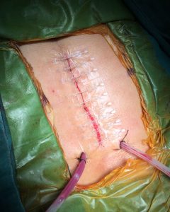 BI-FIX-Wound-Closure-in-Spine-Surgery