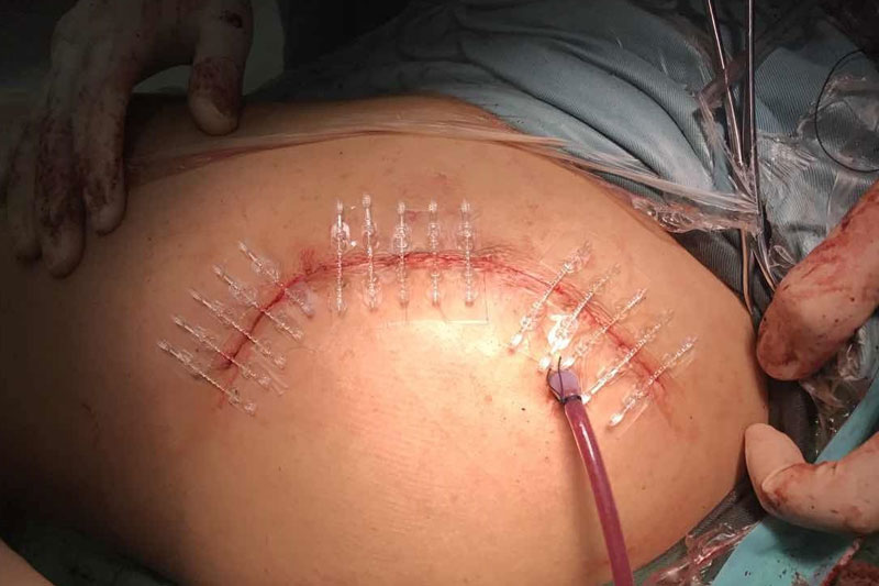 BI-FIX-fermeture-plaie-remplacement-hanche-chirurgie
