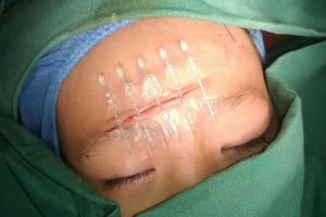 BI-FIX-wound-closure-in-Pediatrics