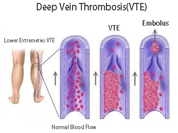 Low Limb VTE