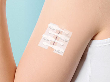 Dispositivo de reducción de la tensión de la piel aplicado a una herida en el brazo