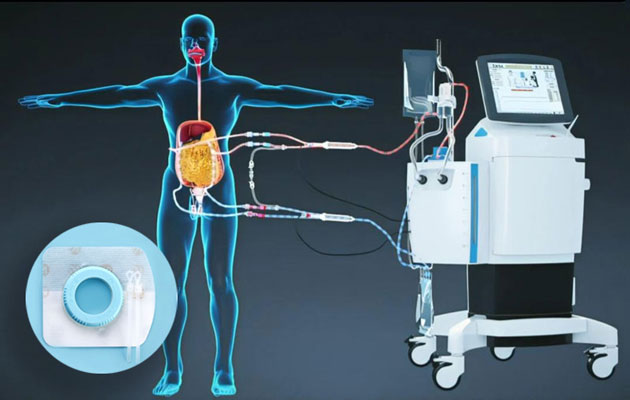 HIPEC-Procedure-and-LOOPIX-Wound-Drainage-Tube-Fixing-Device