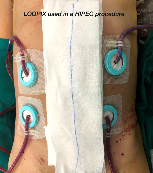 The catheterization situation with LOOPIX secured in a HIPEC treatment procedure