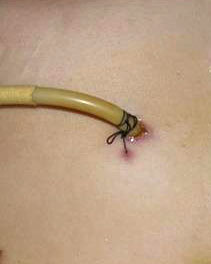 Wound-Drainage-Tube-Secured-by-Suture