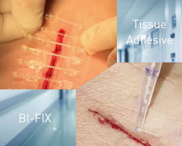 Tissue Adhesive and BI-FIX