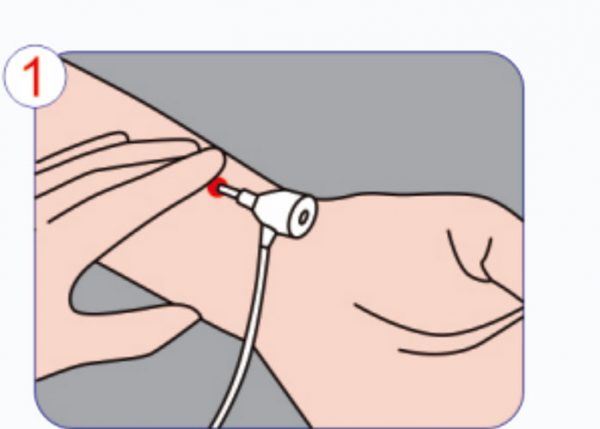 橈骨動脈止血器の適用手順 Step 1