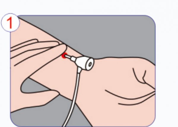 Aplicação-Procedimento-do-Dispositivo-Hemostato-da-Artéria-Radial Etapa 1